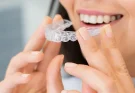 Invisalign Technology